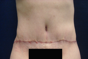 Chicago Tummy Tuck, Chicago Abdominoplasty, mini tummy tuck pictures, tummy tuck, panniculectomy, Chicago Tummy Tuck Surgery, Chicago Abdominoplasty Surgery, tummy tuck photo, tummy tuck picture, Panniculectomy Surgery, Chicago Panniculectomy Surgery, abdominoplasty photo, abdominoplasty picture, tummy tuck in chicago